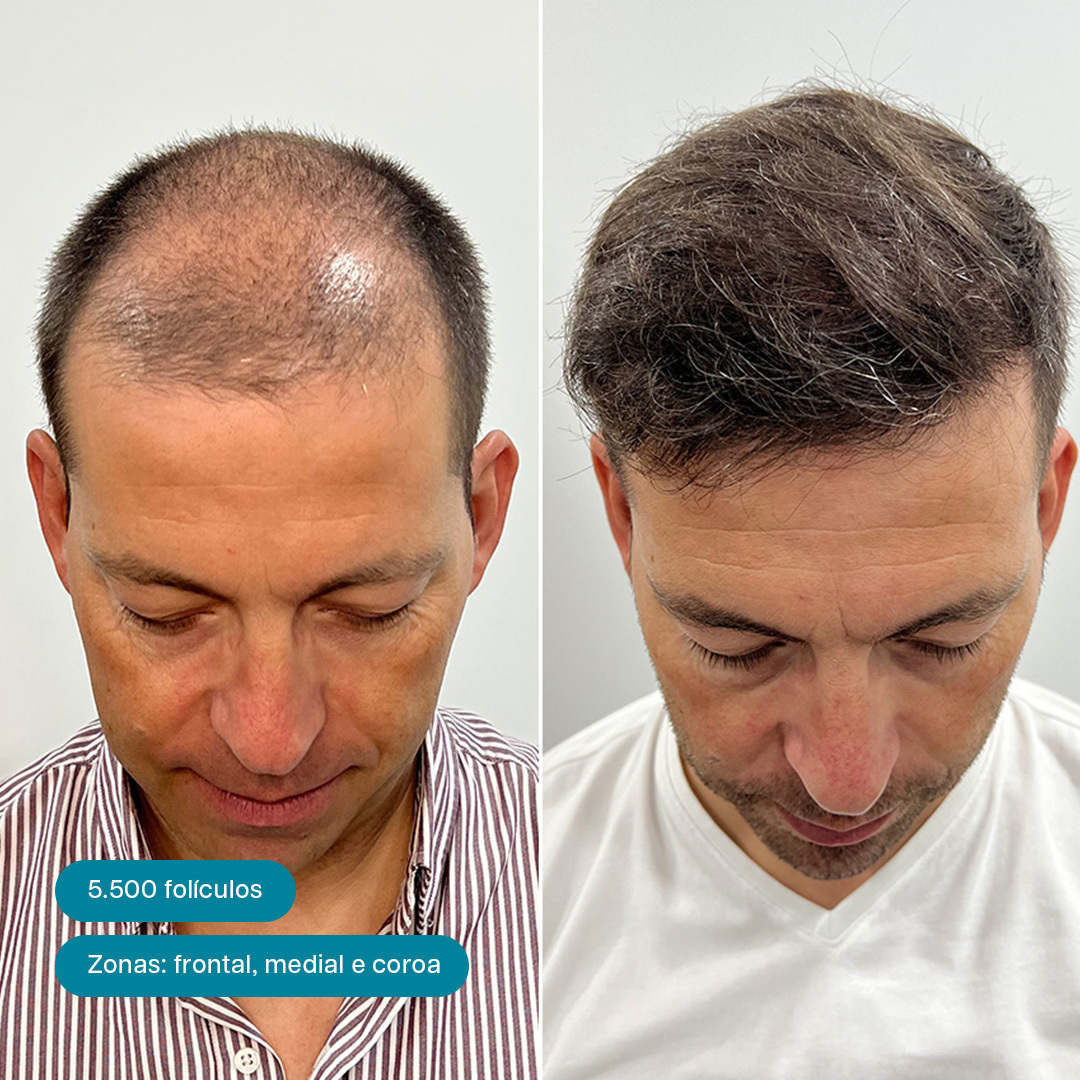 Antes e Depois 1