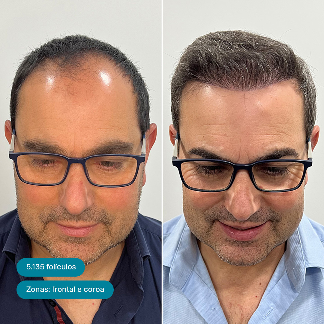 Antes e Depois 8