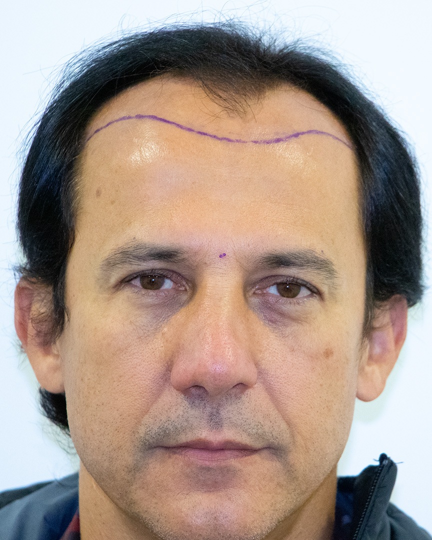 Flávio Melo Antes